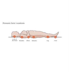 Zones d’escarres en position allongée sur le dos